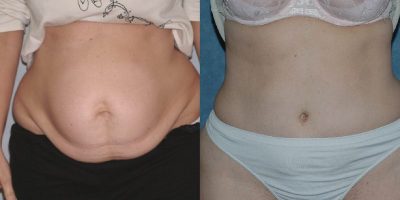 Hyde-Park-Cosmetic-Surgery-Center-Case-_14329-08