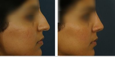 Kulbersh-indian-rhinoplasty1-4-21-17