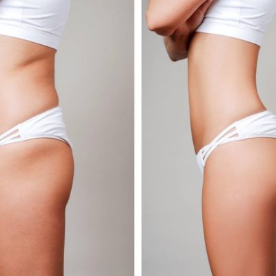 Where-Can-You-Get-Liposuction
