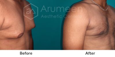 before-after3