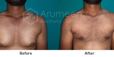 before-after4