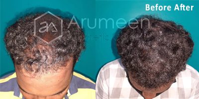 beforeafter