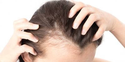 Woman serious hair loss problem for health care shampoo and beauty product concept