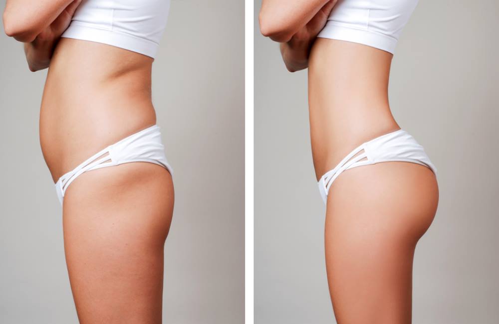 Where-Can-You-Get-Liposuction Where-Can-You-Get-Liposuction