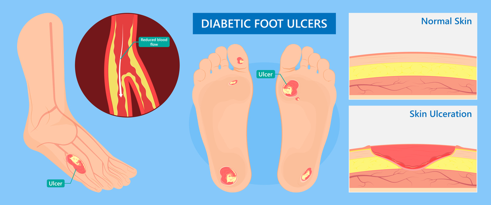 diabetic6 diabetic6