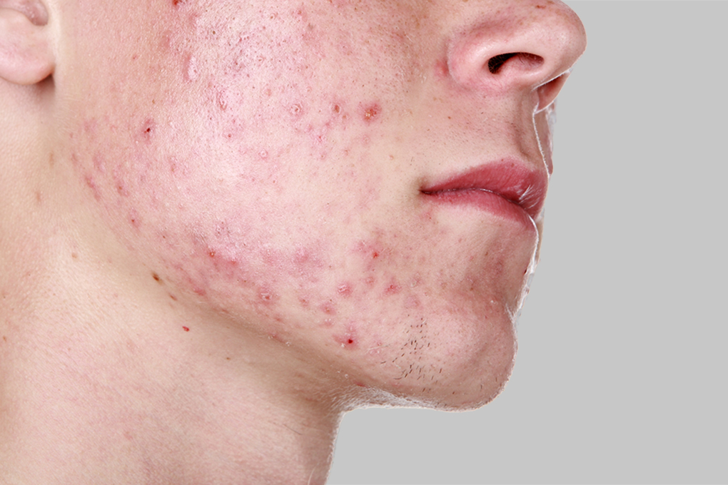 Severe Acne Severe Acne