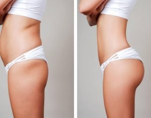 imgi_12_Where-Can-You-Get-Liposuction