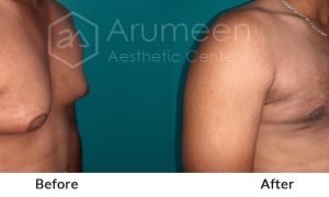 imgi_20_before-after3