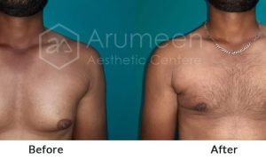 imgi_21_before-after4